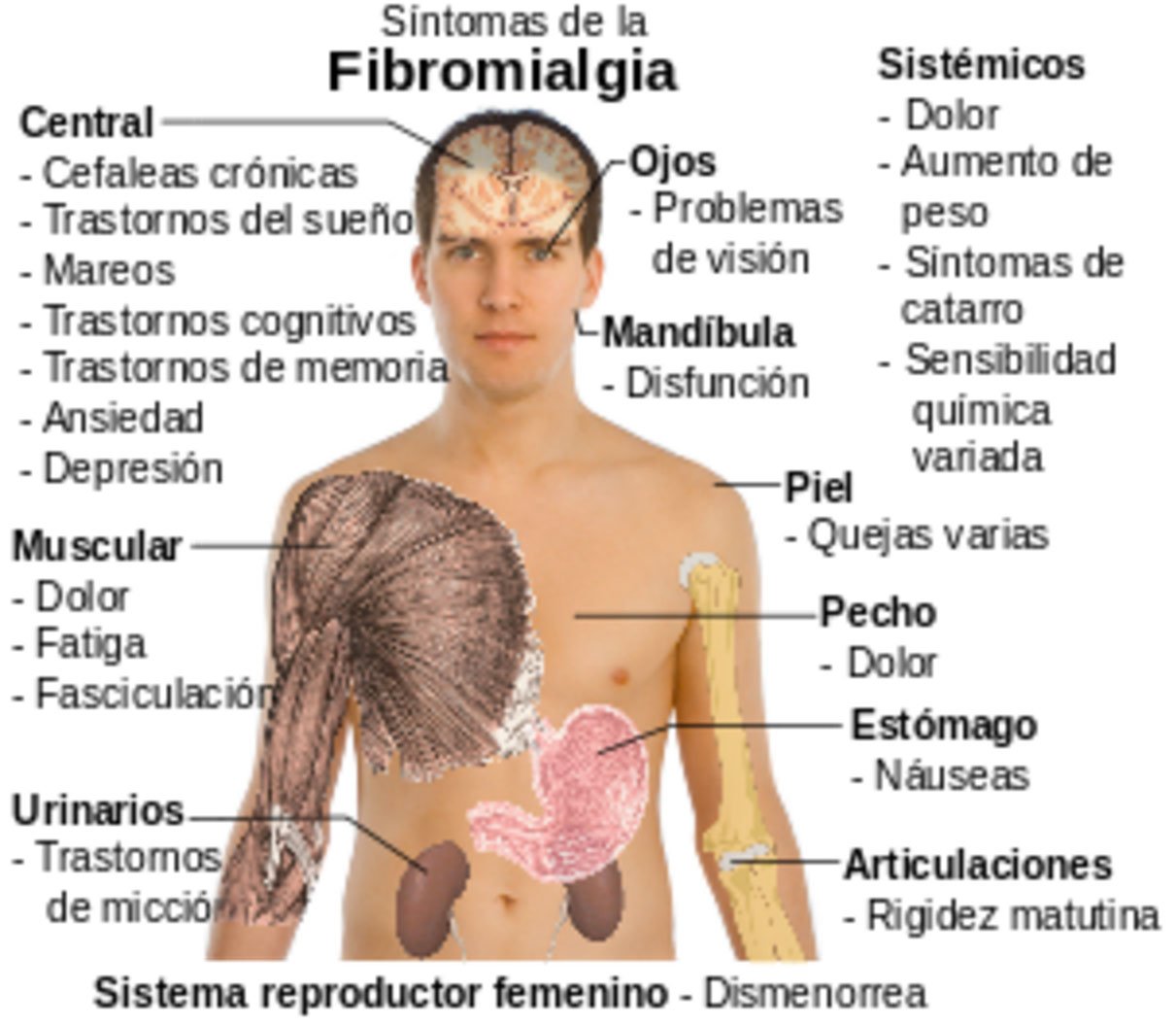 fibromialgia